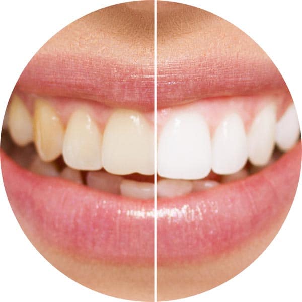 Teeth Whitening Treatment