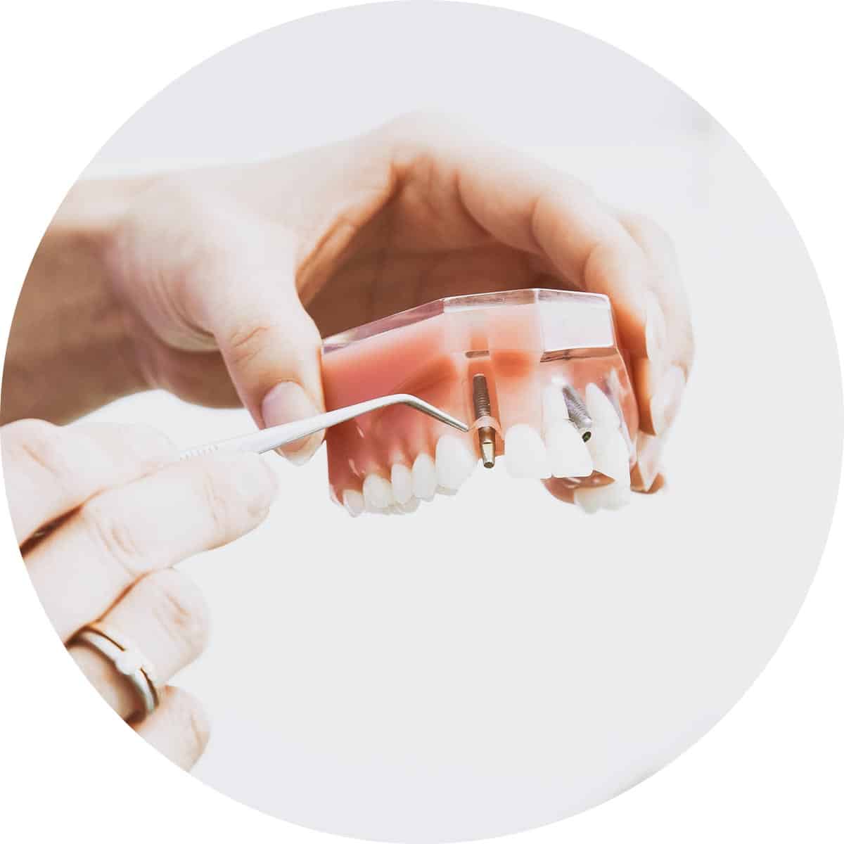 Dental Implants