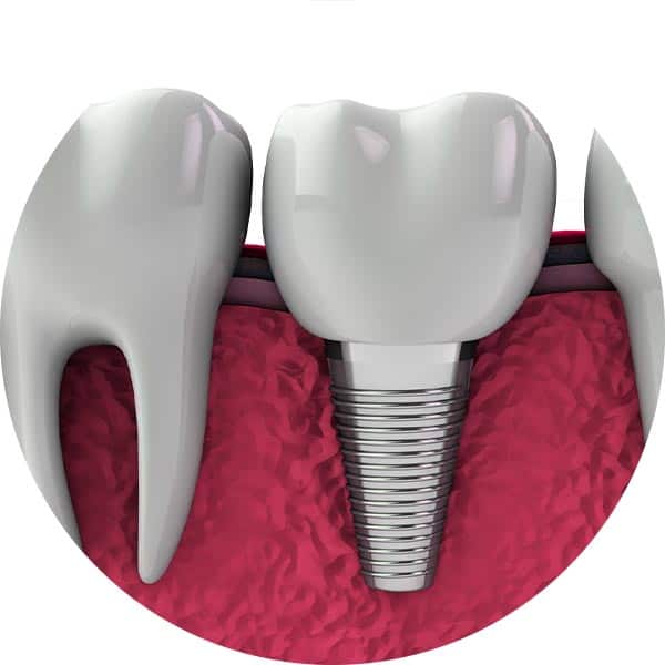 Dental Implants