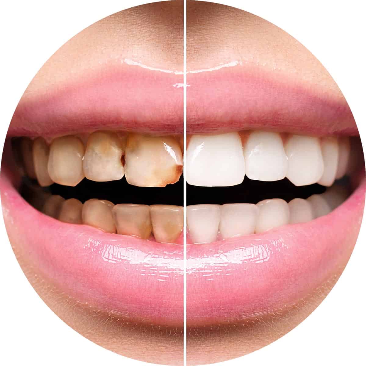 Teeth Whitening Before And After