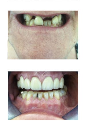 Crowns and Bridges Dental Treatment