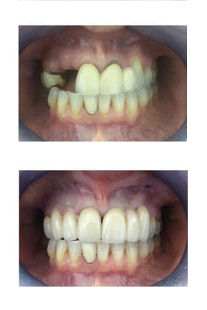 Crowns and Bridges Dental Treatment