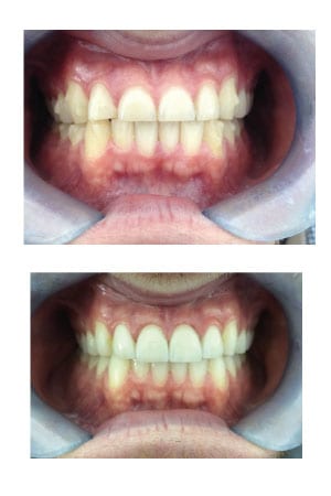 Crowns and Bridges Treatment