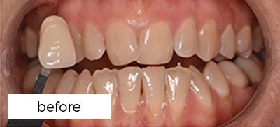 Teeth Whitening Treatment Preston