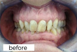 Invisalign Dental Treatment Before