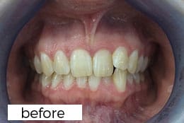 Invisalign Dental Treatment Before