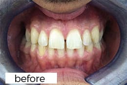 Invisalign Dental Treatment