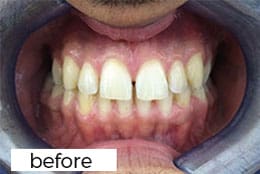 Invisalign Dental Treatment