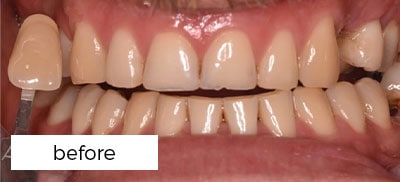 Teeth Whitening Treatment Preston