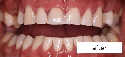 Teeth Whitening Treatment Preston