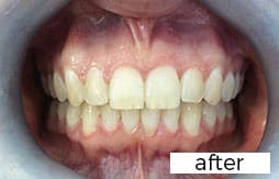 Invisalign Dental Treatment After