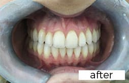 Invisalign Dental Treatment After