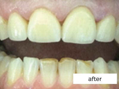 Dental Veneers