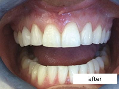 After veneers in PrestonDental Veneers