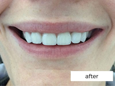 Dental Veneers