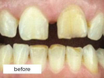 Dental Veneers Before Treatment