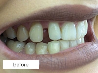 Dental Veneers Before Treatment