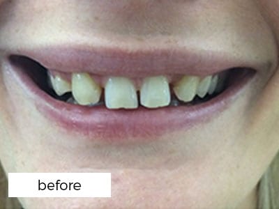 Dental Veneers Before Treatment