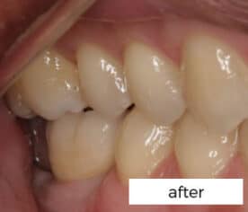 Dental Implants Treatment Preston
