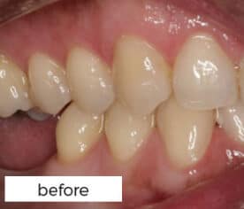 Dental Implants Treatment Preston