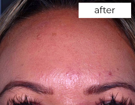 after treatmentFacial Aesthetics Treatment