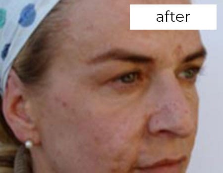 Facial Aesthetics Treatment