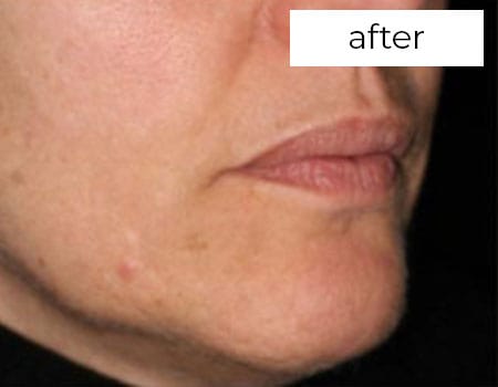 Facial Rejuvenation Treatment