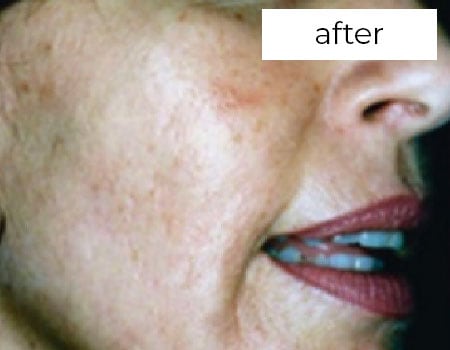Facial Rejuvenation Treatment