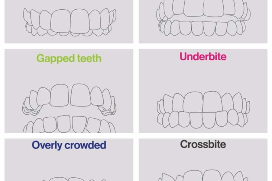 deep open cross bite invisalign