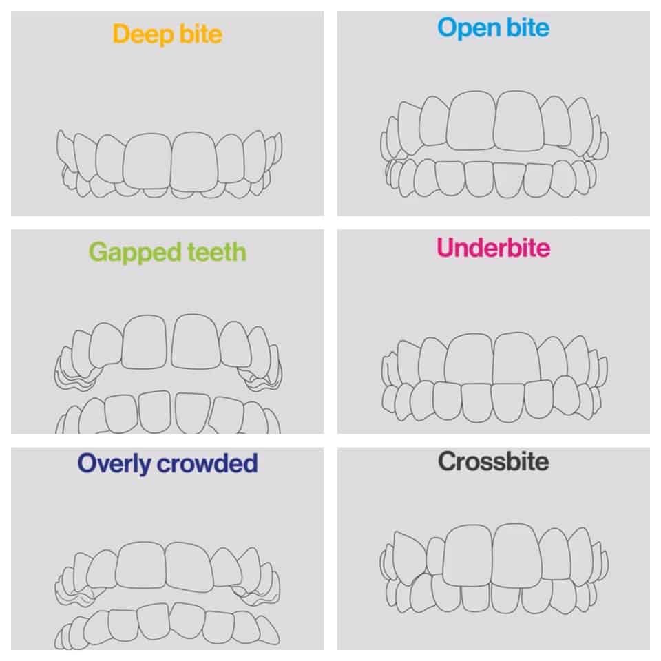 deep open cross bite invisalign