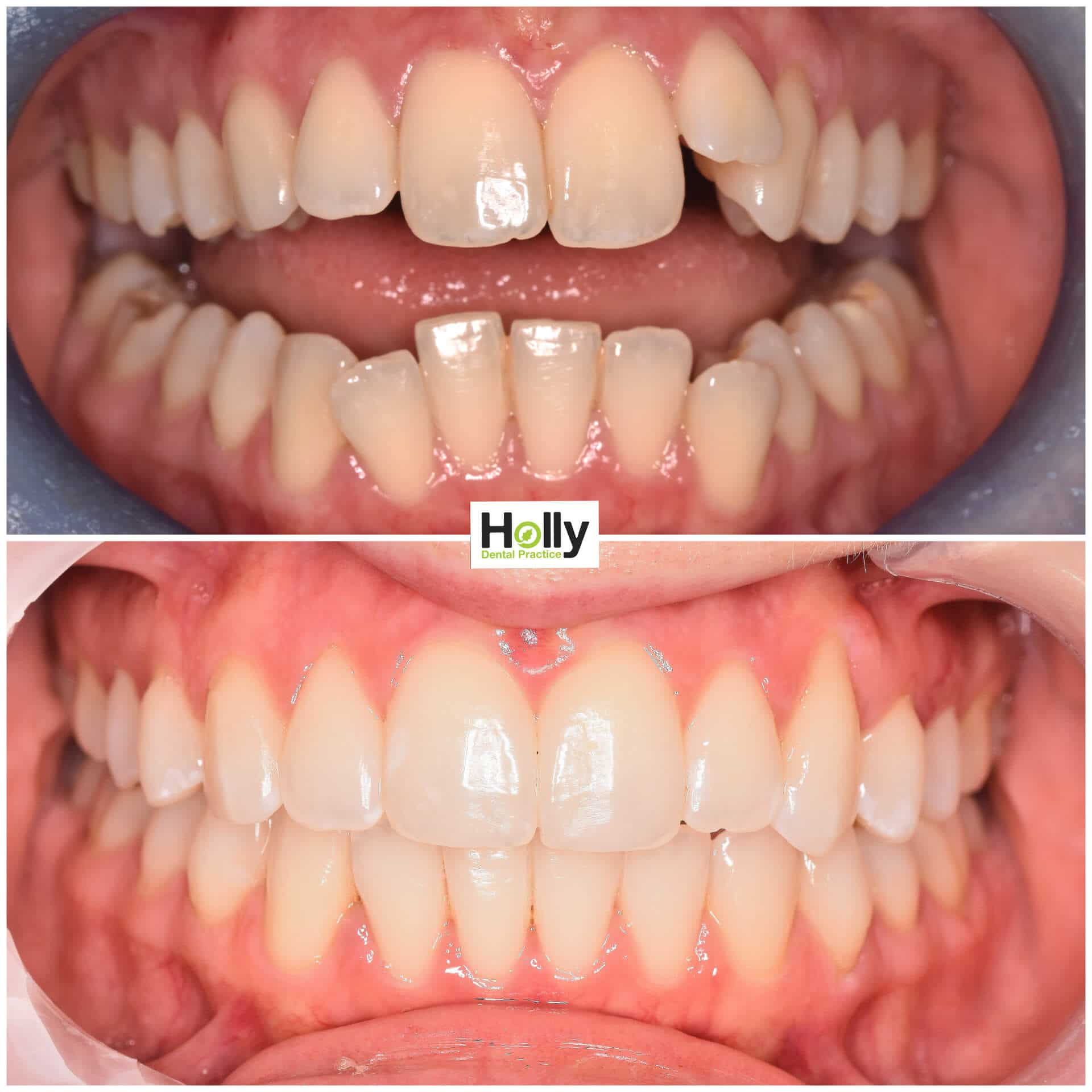 How Long Can It Take to Fix an Overbite with Invisalign?