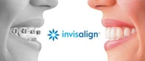 metal braces invisalign