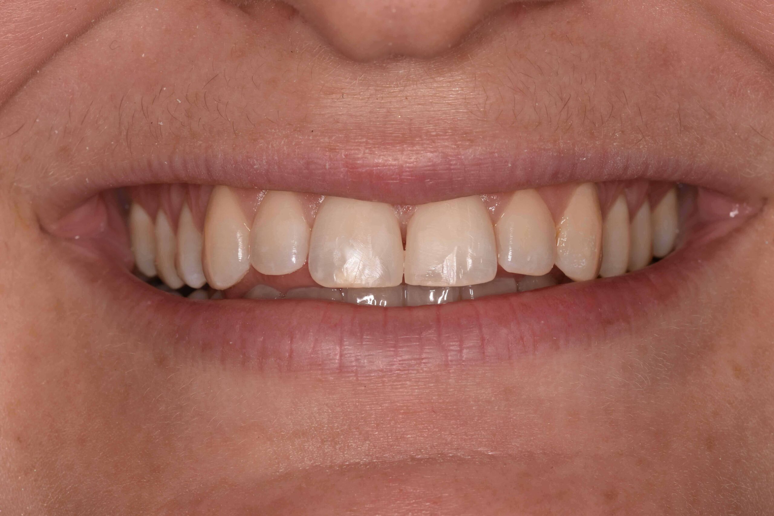 composite veneers before after preston 2