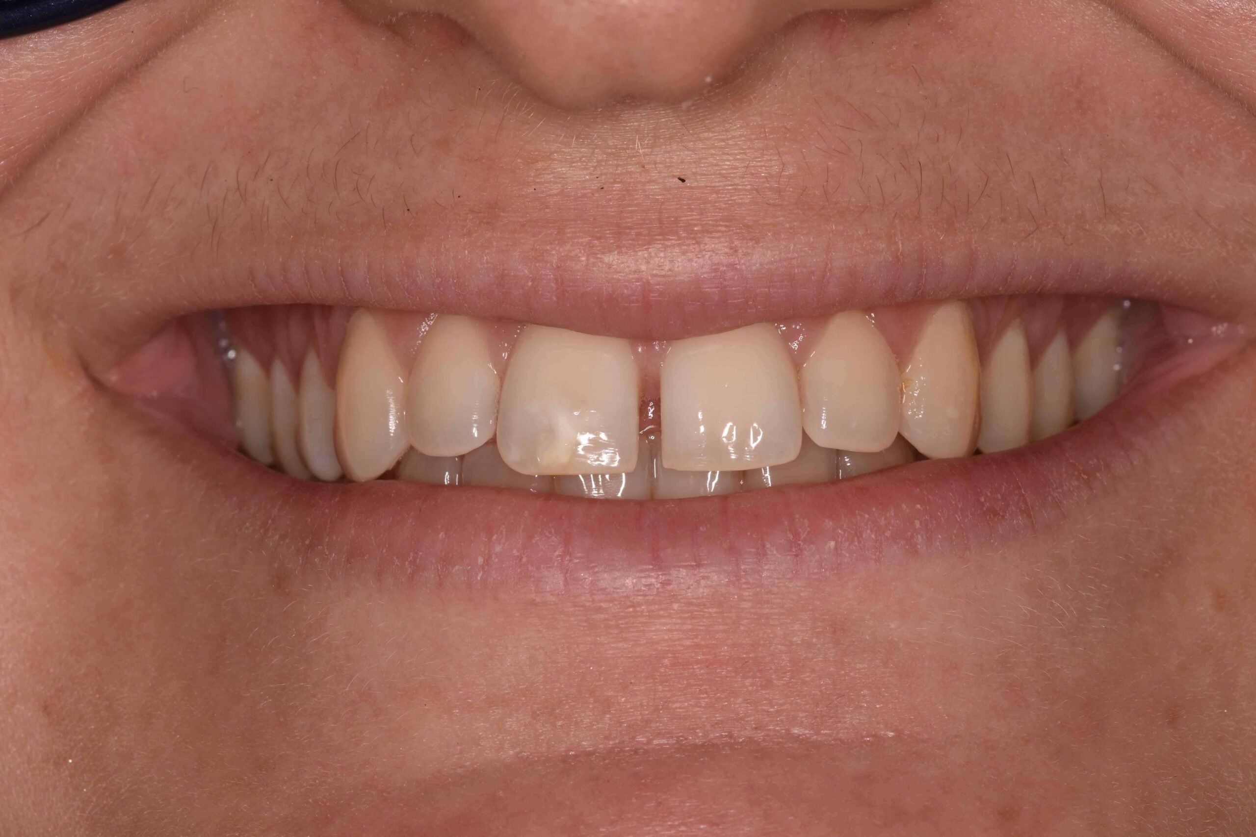 composite veneers before after preston 2