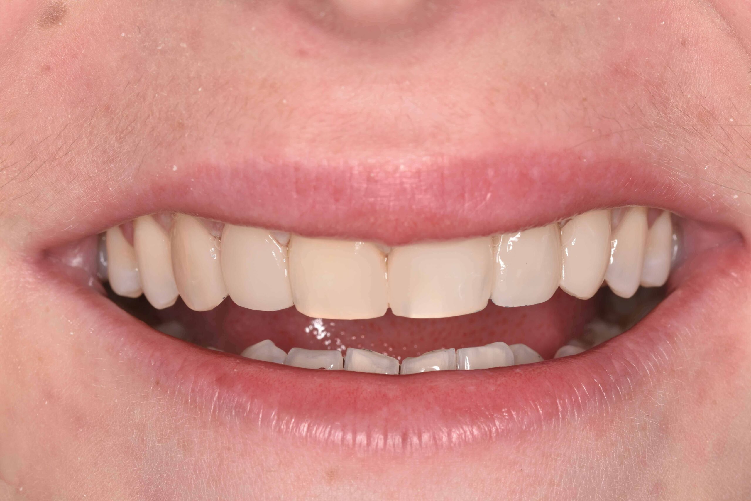 composite veneers before after preston 1