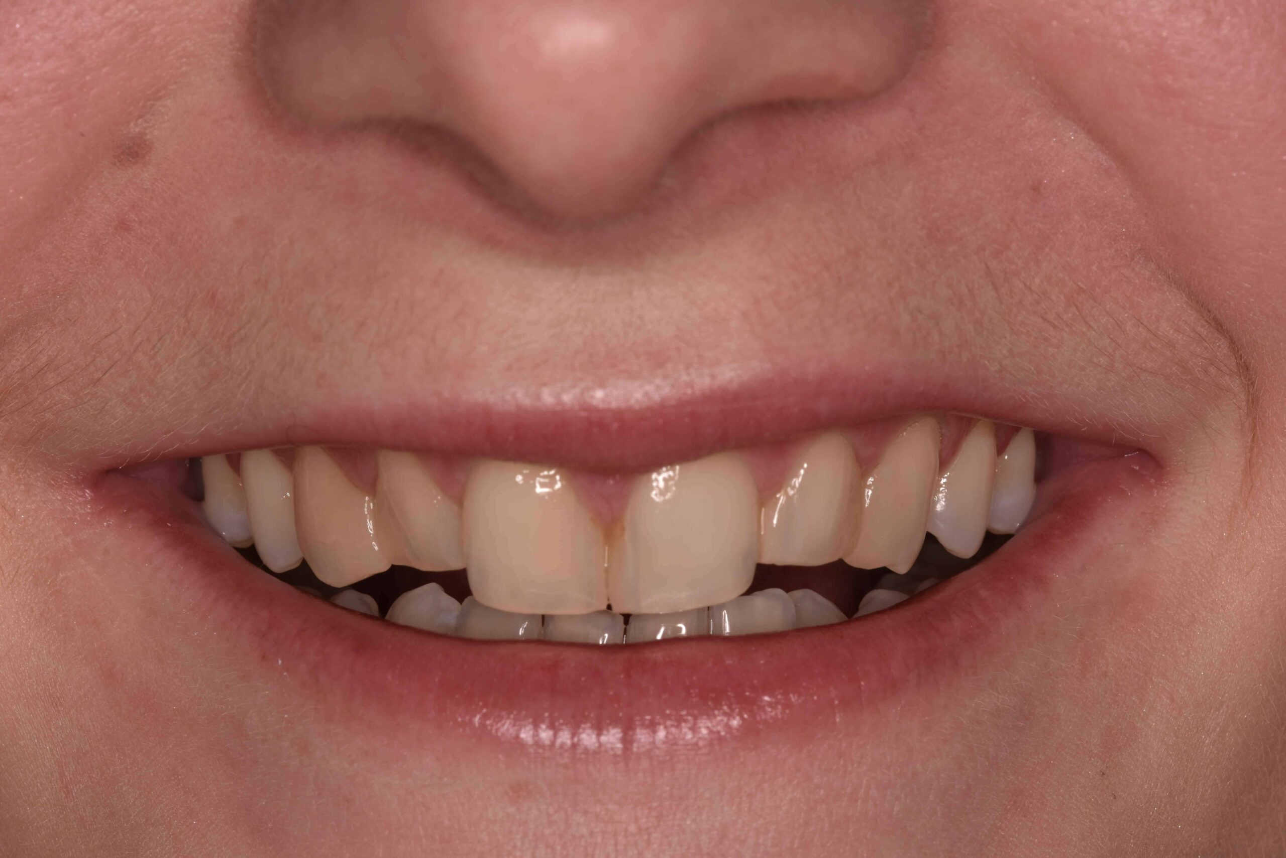 composite veneers before after preston 1