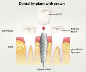 what is a dental implant