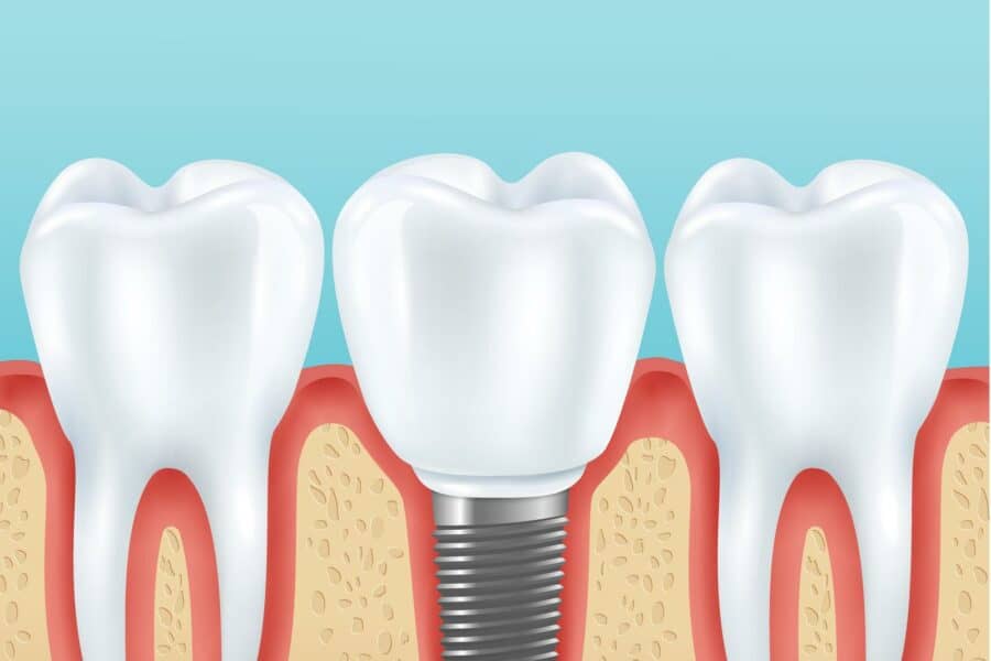 types of dental implants