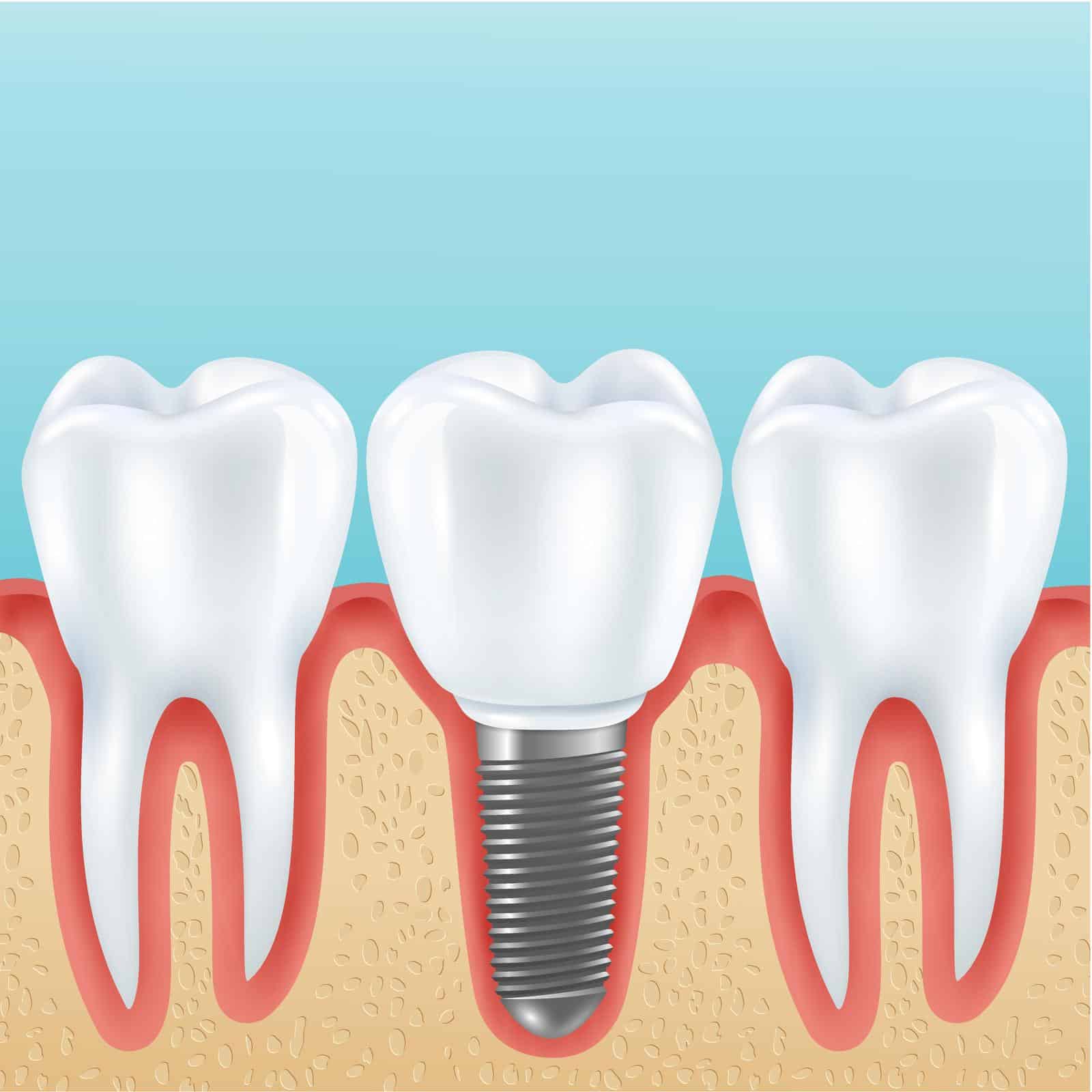 types of dental implants