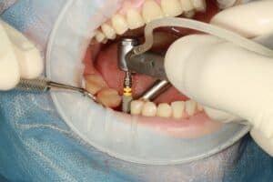 dental implant surgeon lancashire