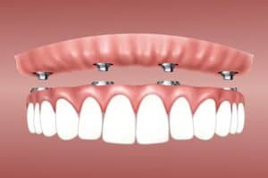 all on 4 dental implants preston