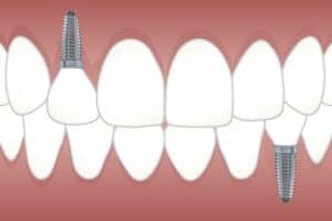 dental implants preston