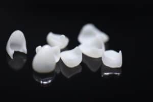 composite porcelain veneers