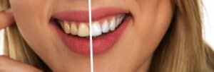 teeth staining composite bonding