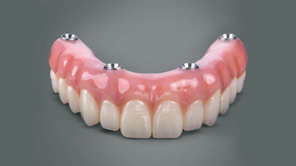dental implants preston