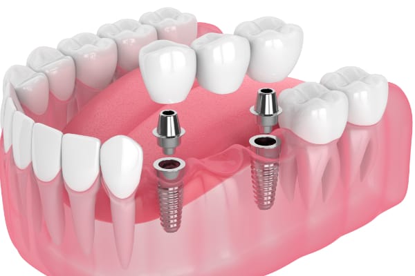 implant bridge