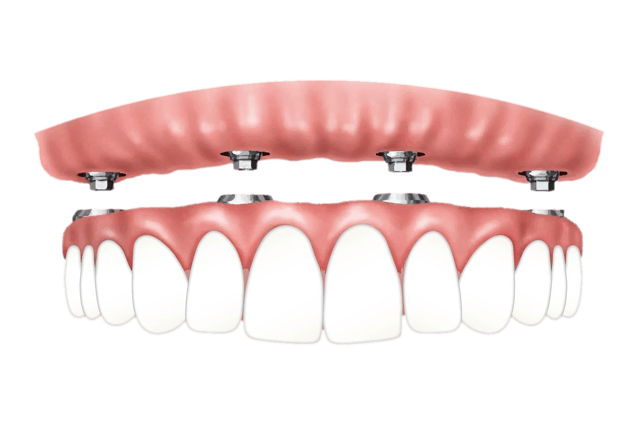 same day dental implants preston
