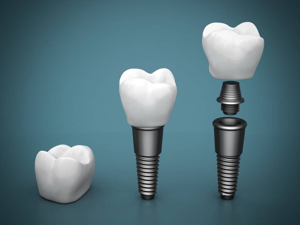 Dental implants