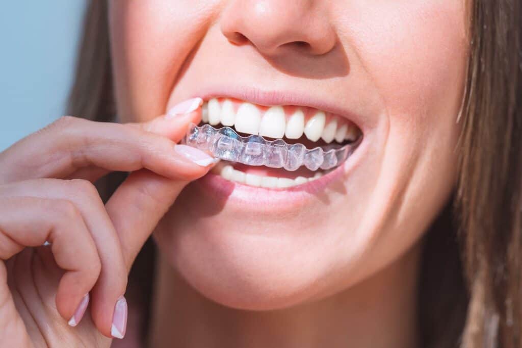 Invisalign Preston