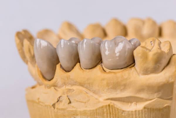 dental implants in Preston